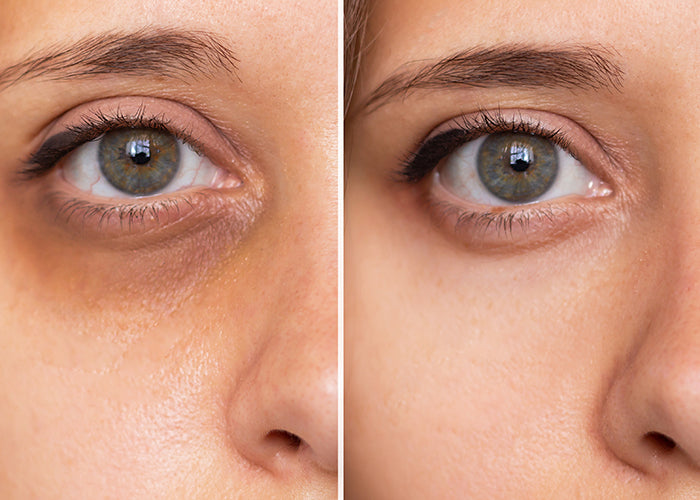 MASCHERA PER PRESSOTERAPIA OCULARE